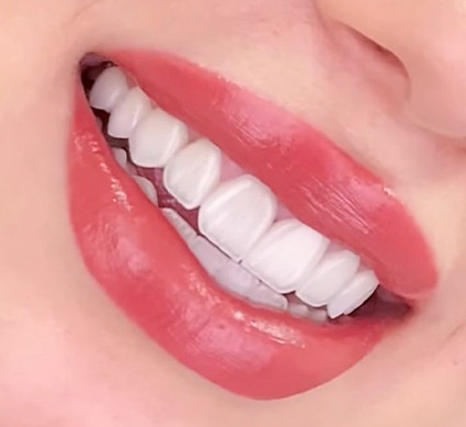 ابتسامة هوليوود 3D